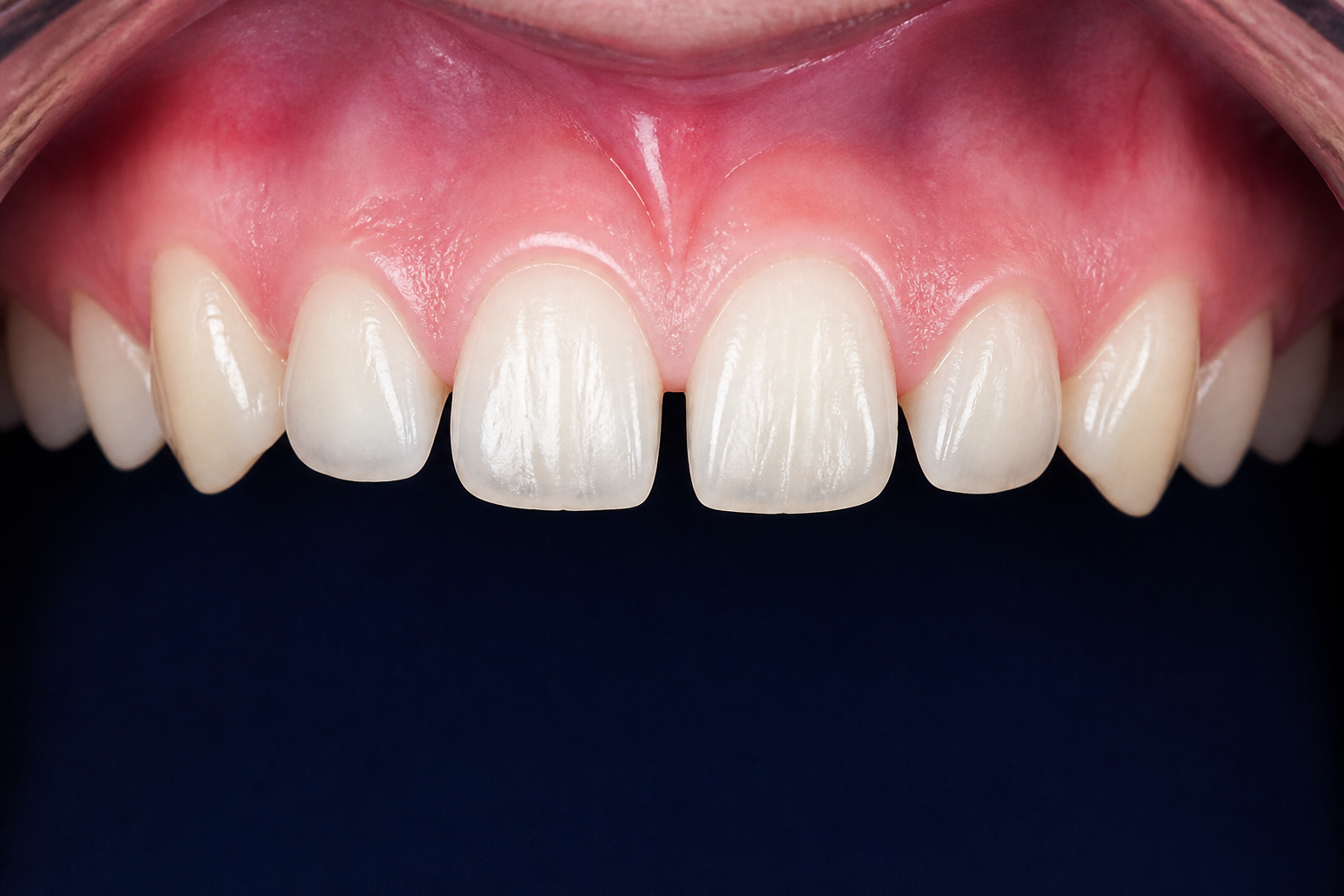 Overbite before